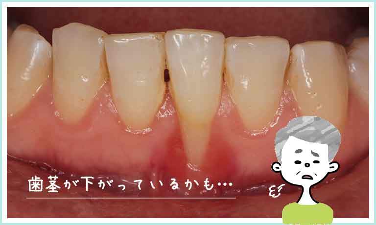 根面齲蝕