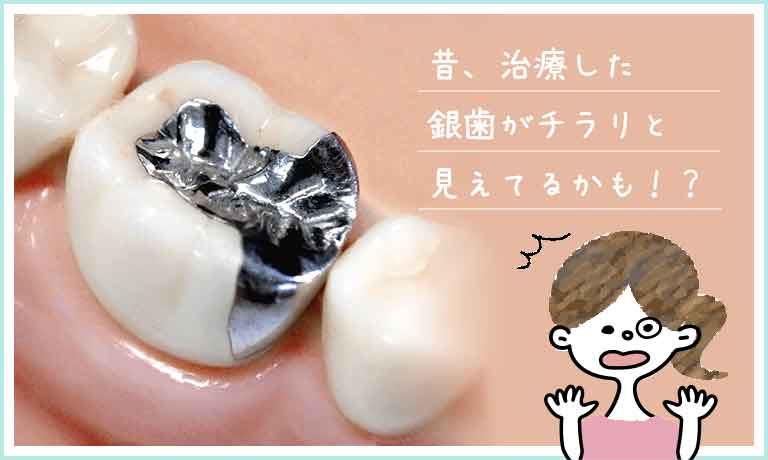 銀歯が気になる方へ