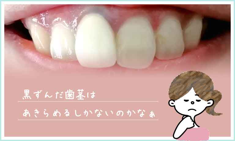 歯茎をピンク色にしたい方へ