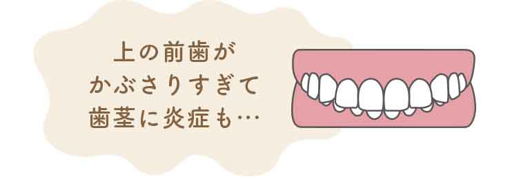 過蓋咬合